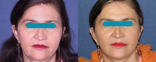 Rejuvenecimiento facial o Ritidoplastia