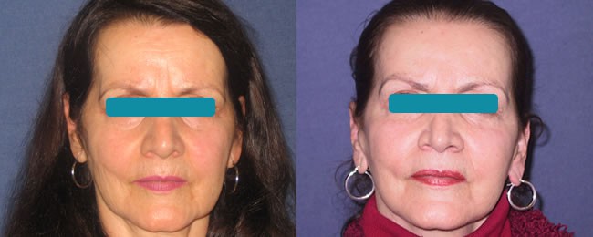 Rejuvenecimiento facial o Ritidoplastia